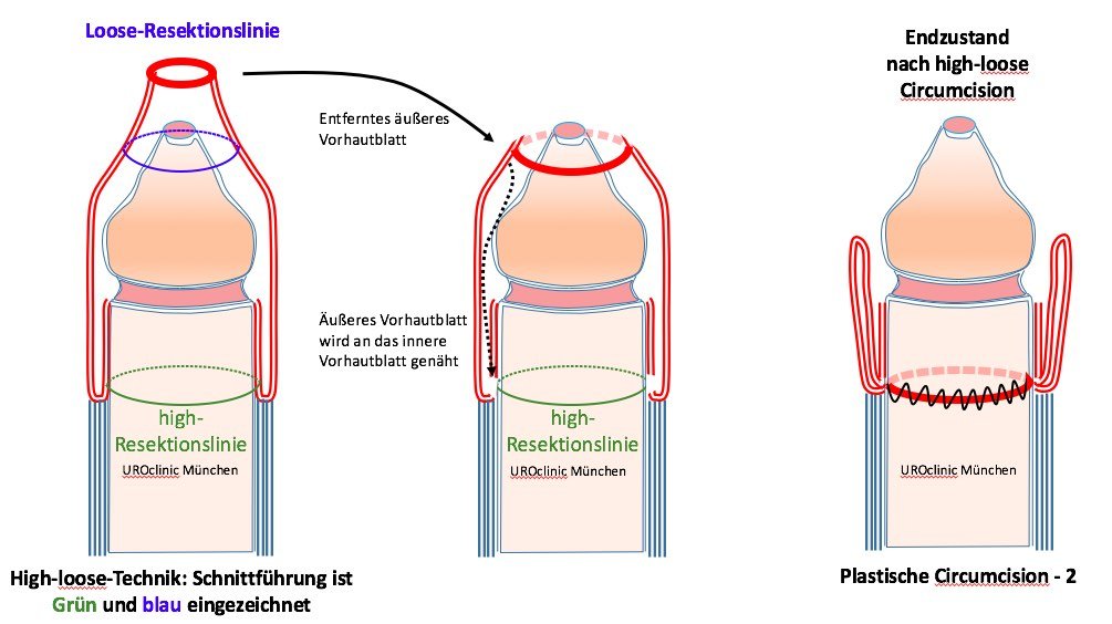 Beschneidung low tight Circumcision Styles