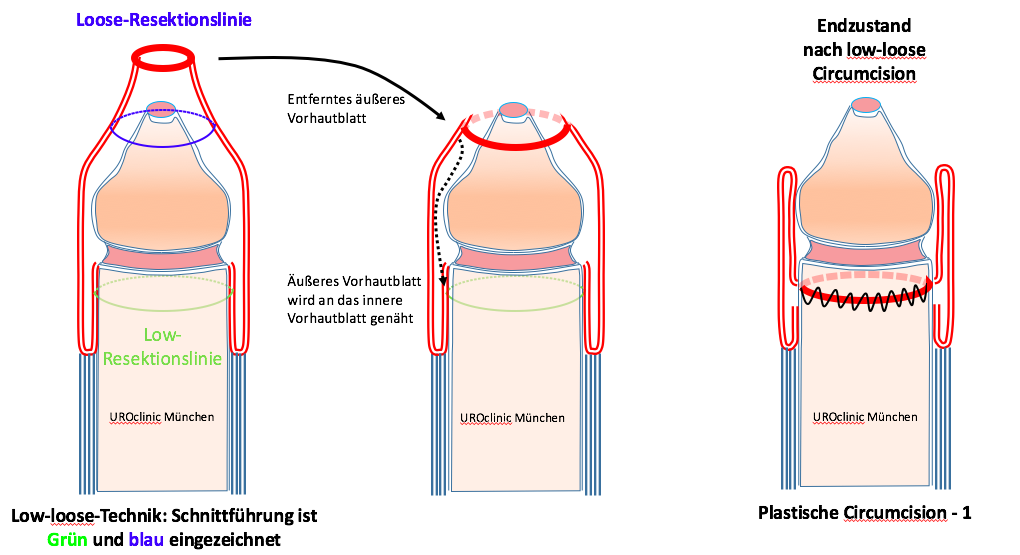 beschneidung-dr-seitz-muenchen.png